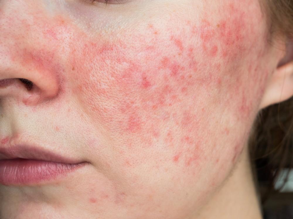 Can You Be Too Young to Have Rosacea?