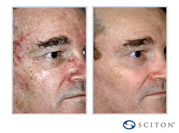 Sciton Contour TRL Before & After photo of man